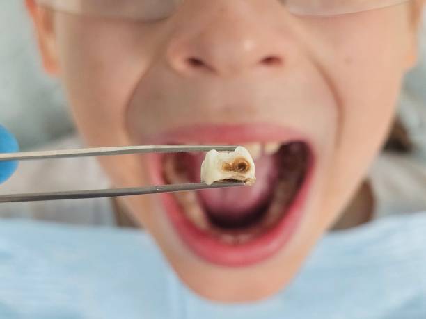 Best Dentist for Tooth Abscess  in Monroe, IA